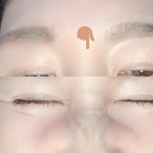 シワ取りボトックス 湘南美容クリニック 藤沢院 DAY 29 メイン用