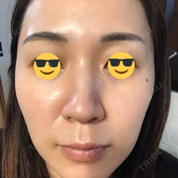 ダーマペン AURORA CLINIC（オーロラクリニック）新宿院 AFTER メイン用