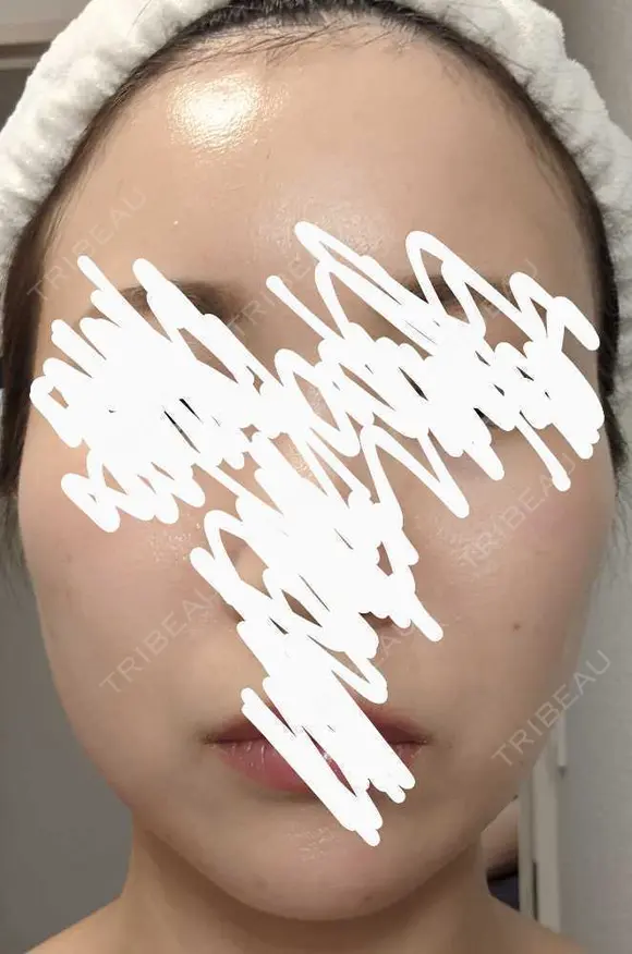 ボトックス（エラ・小顔） 湘南美容クリニック 静岡院 DAY 14 メイン用