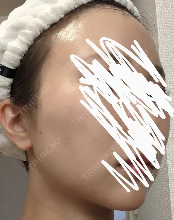 ボトックス（エラ・小顔） 湘南美容クリニック 静岡院 DAY 14 メイン用