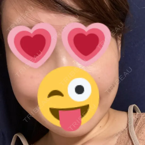 ボトックス（エラ・小顔） 湘南美容クリニック 武蔵小杉院 DAY 6 メイン用