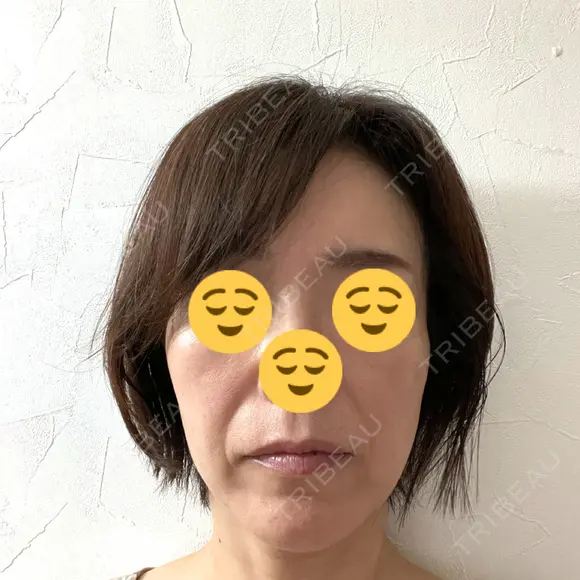 プラセンタ注射 / ハイフ（顔） 心斎橋藤井クリニック DAY 17 メイン用