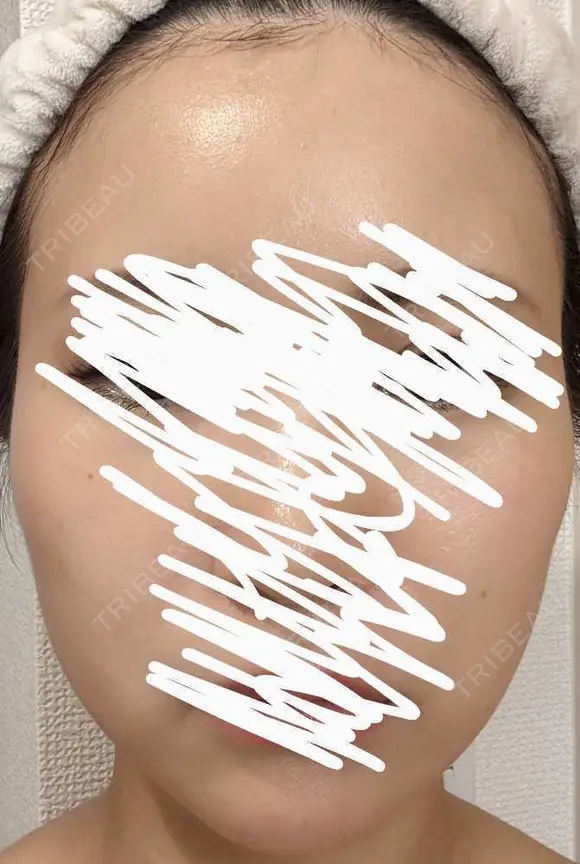 ボトックス（エラ・小顔） 湘南美容クリニック 静岡院 DAY 19 メイン用