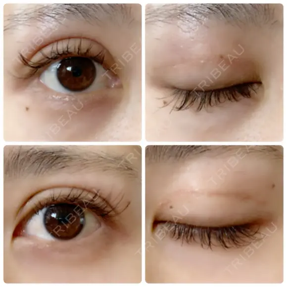 二重切開 / 上まぶたたるみ取り 城本クリニック 姫路院 DAY 66 メイン用