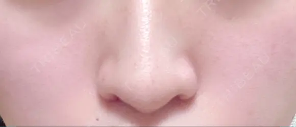 小鼻縮小（切開） / その他（鼻） みずほクリニック DAY 44 メイン用