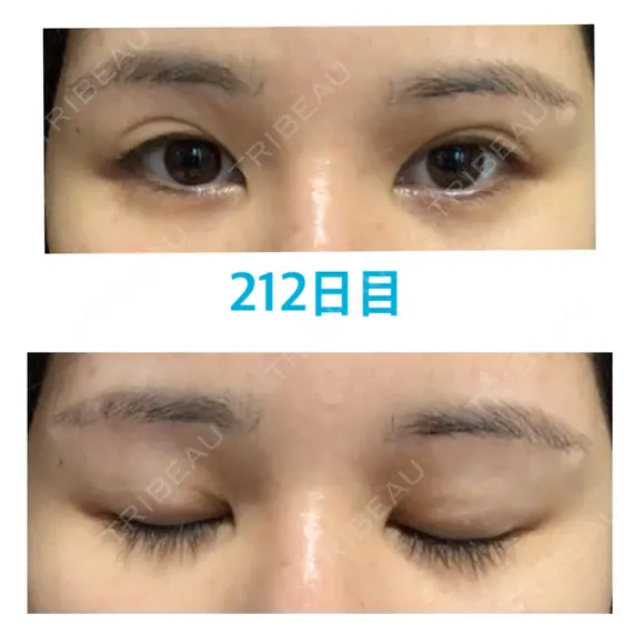 上まぶたの脂肪取り / 眉下切開 JUN CLINIC AFTER メイン用