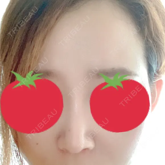 隆鼻術 / 鼻中隔延長（切開） / 軟骨移植 / 鼻尖縮小 しらさぎ形成クリニック 徳島院 AFTER メイン用