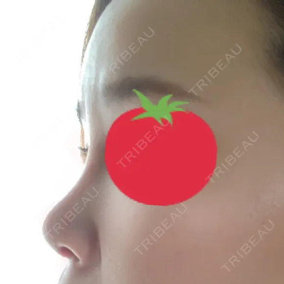 隆鼻術 / 鼻中隔延長（切開） / 軟骨移植 / 鼻尖縮小 しらさぎ形成クリニック 徳島院 DAY 61 メイン用