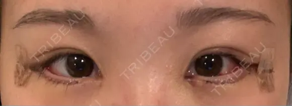 目尻切開 / タレ目形成・グラマラスライン（切開） / 目尻靭帯移動 アネシス美容クリニック DAY 4 メイン用