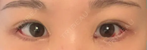 目尻切開 / タレ目形成・グラマラスライン（切開） / 目尻靭帯移動 アネシス美容クリニック DAY 5 メイン用