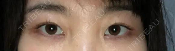 二重切開 / 眼瞼下垂（切開） ブリスクリニック形成外科・美容外科・美容皮膚科 福岡 DAY 142 メイン用