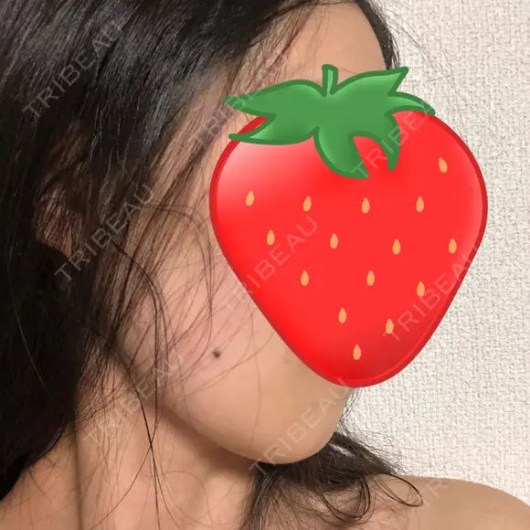 骨切り（あご） / 骨削り（エラ） リラ・クラニオフェイシャル・クリニック DAY 74 メイン用