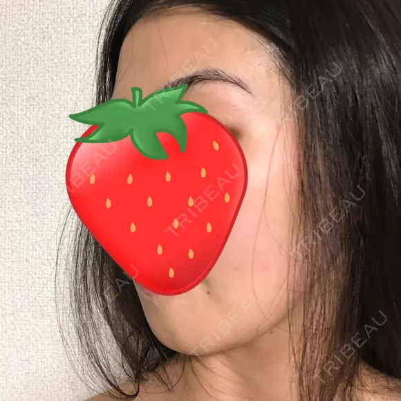 骨切り（あご） / 骨削り（エラ） リラ・クラニオフェイシャル・クリニック DAY 74 メイン用