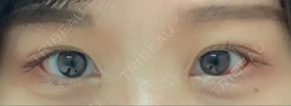 目尻切開 / タレ目形成・グラマラスライン（切開） / 目尻靭帯移動 アネシス美容クリニック DAY 9 メイン用