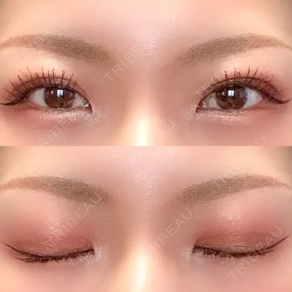 二重埋没 / 自然癒着法 シンデレラ＆ダヴィンチクリニック DAY 70 メイン用