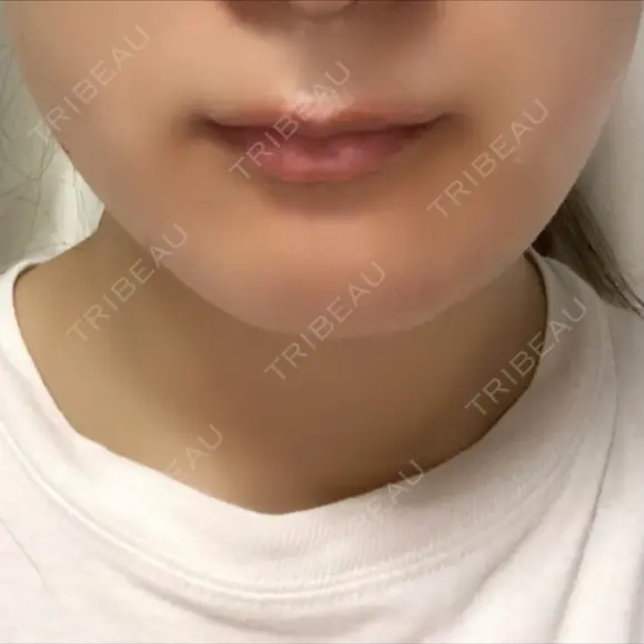 その他（輪郭） リラ・クラニオフェイシャル・クリニック DAY 94 メイン用