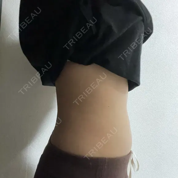 脂肪冷却（お腹） / その他（ボディ） 湘南美容クリニック 所沢院 DAY 8 メイン用