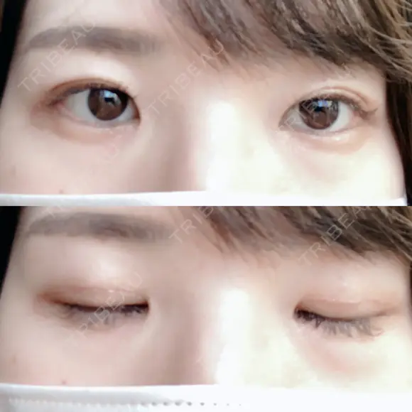 二重切開 松下皮フ形成外科 DAY 36 メイン用