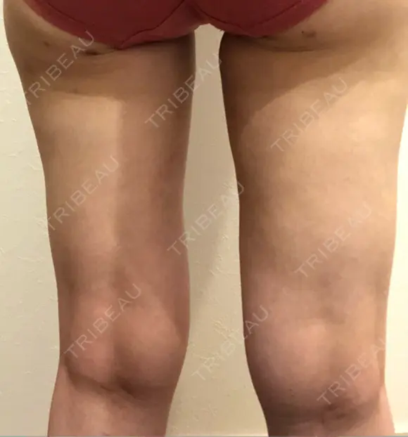 脂肪吸引（脚） 湘南美容クリニック 新潟院 AFTER メイン用