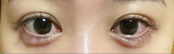 二重埋没 / 目頭切開 / 目尻切開 / タレ目形成・グラマラスライン（切開） HAAB×DREAM BEAUTY CLINIC 東京本院 AFTER メイン用