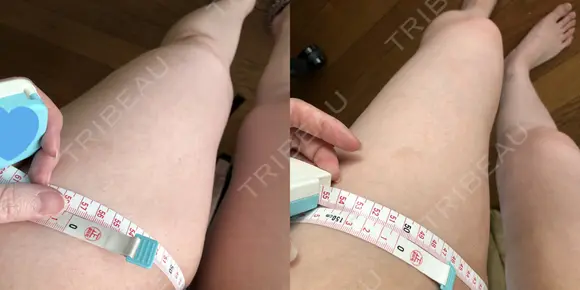 脂肪吸引（脚） / 脂肪吸引（お尻） / 豊胸（脂肪注入） / ボトックス（ふくらはぎ） Mods Clinic（モッズクリニック） 東京院 DAY 179 メイン用