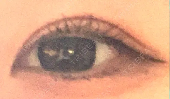 二重切開 / 上まぶたの脂肪取り たにまちクリニック DAY 54 メイン用