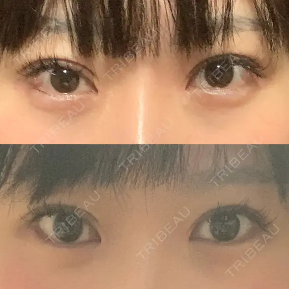 二重埋没 TCB東京中央美容外科 心斎橋筋院 AFTER メイン用