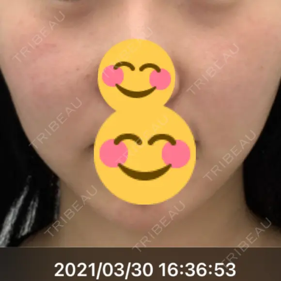 レーザートーニング（美白・肝斑） R.O.clinic AFTER メイン用