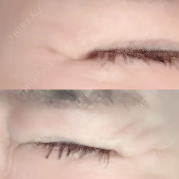 シワ取りボトックス 湘南美容クリニック 藤沢院 AFTER メイン用