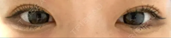 二重切開 / 上まぶたの脂肪取り たにまちクリニック DAY 55 メイン用