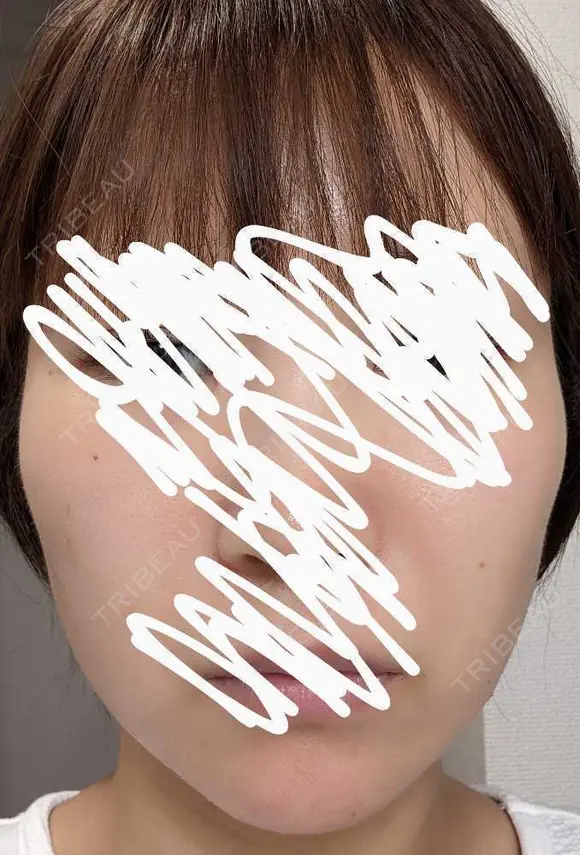 ボトックス（エラ・小顔） 湘南美容クリニック 静岡院 AFTER メイン用