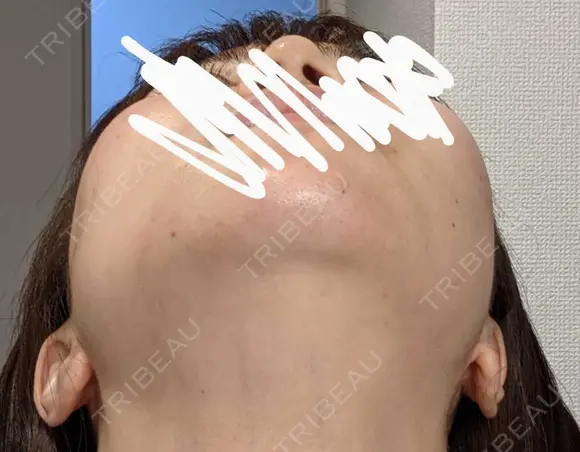 ボトックス（エラ・小顔） 湘南美容クリニック 静岡院 DAY 30 メイン用