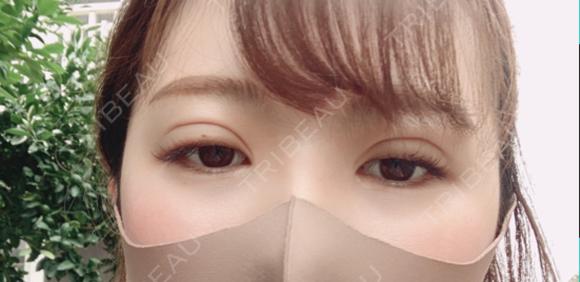二重埋没 湘南美容クリニック 渋谷院 DAY 1 メイン用