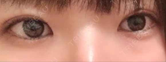 二重切開 松下皮フ形成外科 DAY 39 メイン用