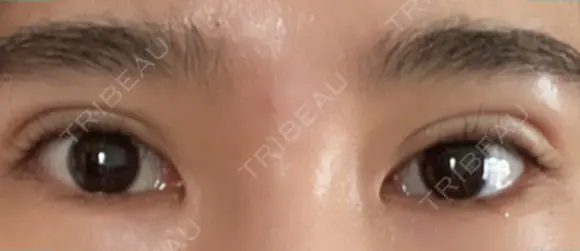 二重切開 松下皮フ形成外科 DAY 19 メイン用