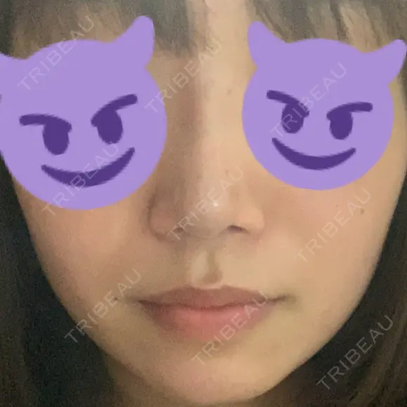 鼻尖形成（切開） / ヒアルロン酸注入（鼻） / ヒアルロン酸注入（あご） 東京ヒルズクリニック 新宿院 DAY 0 メイン用