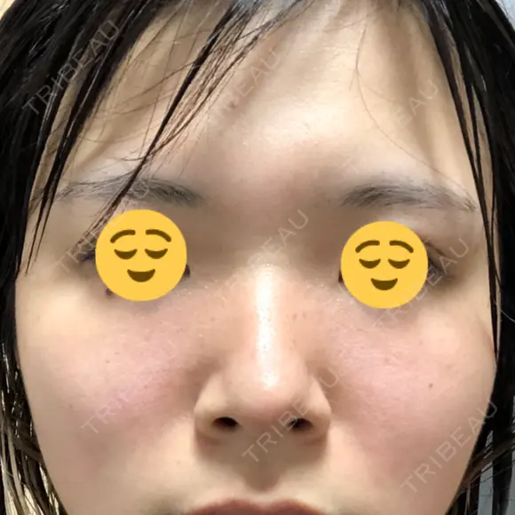軟骨移植 フェアクリニック川口 DAY 7 メイン用
