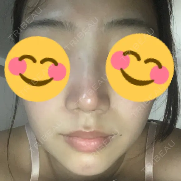 鼻尖形成（切開） / ヒアルロン酸注入（鼻） / ヒアルロン酸注入（あご） 東京ヒルズクリニック 新宿院 DAY 1 メイン用