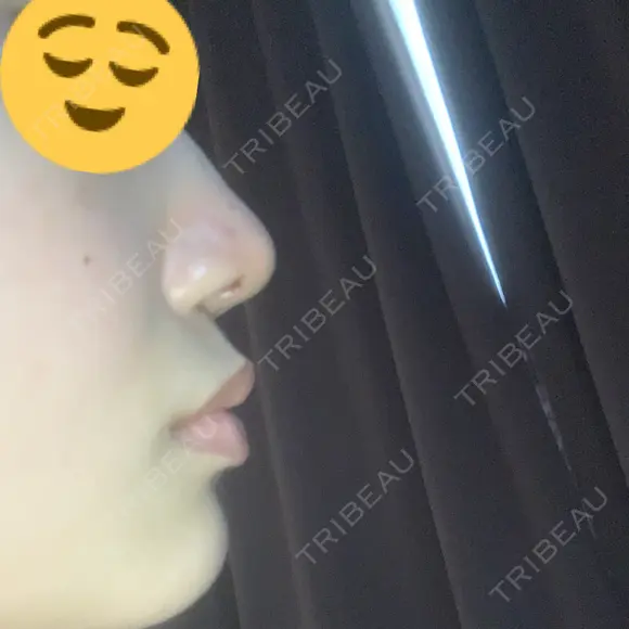 鼻尖形成（切開） / ヒアルロン酸注入（鼻） / ヒアルロン酸注入（あご） 東京ヒルズクリニック 新宿院 DAY 1 メイン用