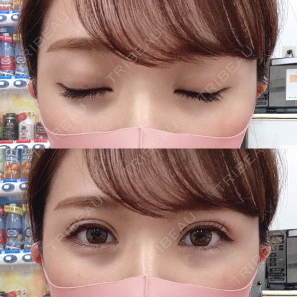 二重埋没 湘南美容クリニック 渋谷院 DAY 3 メイン用