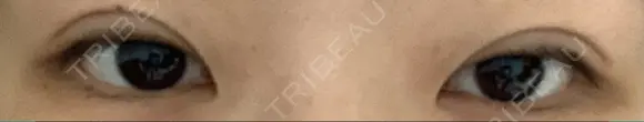 二重切開 / 上まぶたの脂肪取り たにまちクリニック DAY 56 メイン用