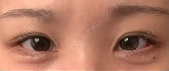 目尻切開 / タレ目形成・グラマラスライン（切開） / 目尻靭帯移動 アネシス美容クリニック DAY 16 メイン用