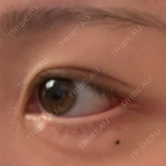 目尻切開 / タレ目形成・グラマラスライン（切開） / 目尻靭帯移動 アネシス美容クリニック DAY 16 メイン用