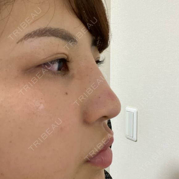 ヒアルロン酸注入（鼻） TCB東京中央美容外科 八王子院 DAY 9 メイン用