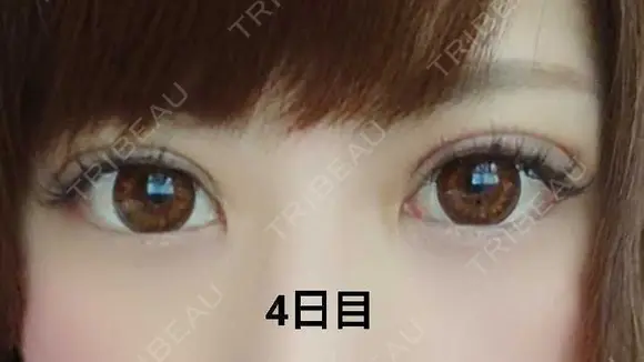 二重埋没 品川美容外科 福岡院 DAY 4 メイン用