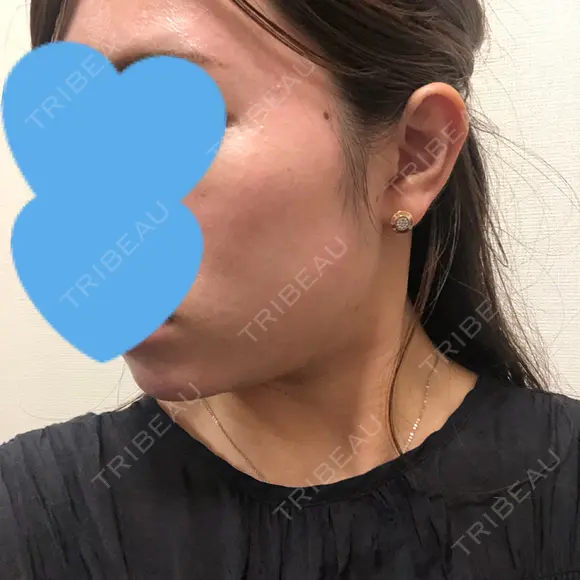 脂肪溶解注射（顔） UB CLINIC銀座 DAY 46 メイン用