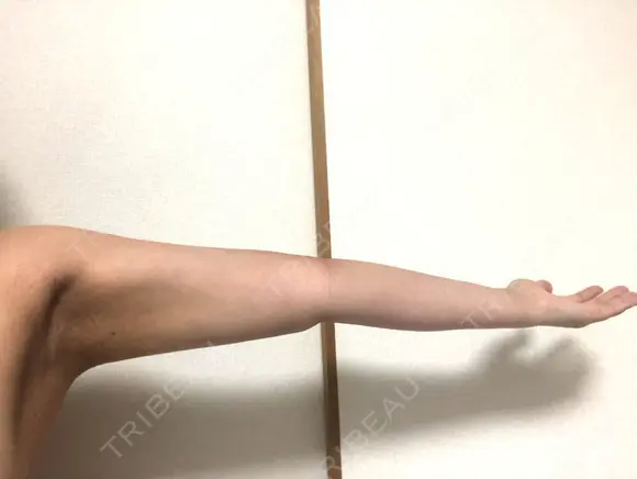 脂肪吸引（二の腕） 銀座マイアミ美容外科 DAY 16 メイン用