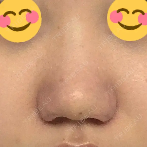 小鼻縮小（切開） / 鼻翼挙上 / 鼻孔縁挙上 くさのたろうクリニック DAY 8 メイン用
