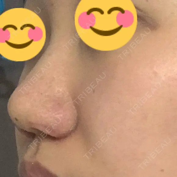 小鼻縮小（切開） / 鼻翼挙上 / 鼻孔縁挙上 くさのたろうクリニック DAY 8 メイン用