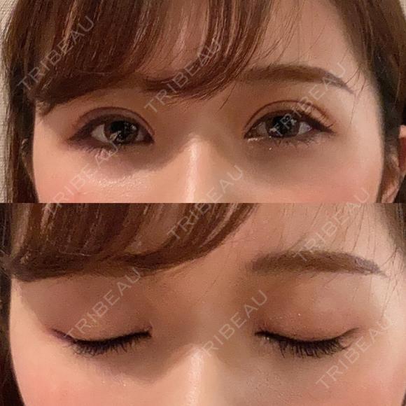二重埋没 湘南美容クリニック 渋谷院 DAY 6 メイン用
